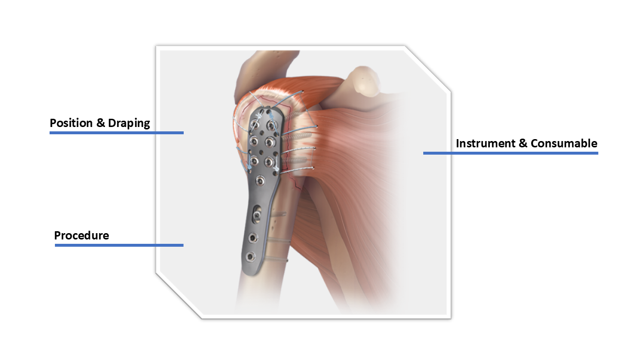 Proximal Humeral Fracture Plating